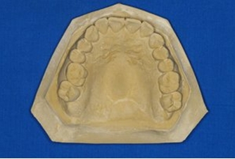 解析:修整后的模型  下颌前牙按下颌前牙形态修成一致的弧形,两侧