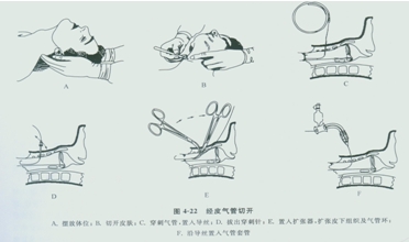 经皮微创气管切开的步骤如图所示,是光学的视频喉镜,在植入导管时