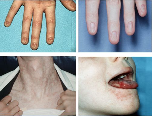 治疗包括雄激素,g-csf,epo.sct效果不佳.