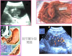 右图为结节蕈散型胃癌.彩超示内部血流丰富.