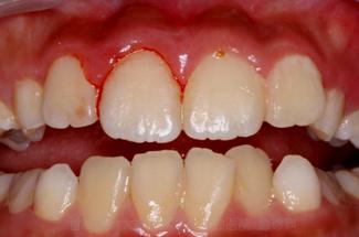 流行分布及病因                     牙齿半脱位和牙震荡的区别就是