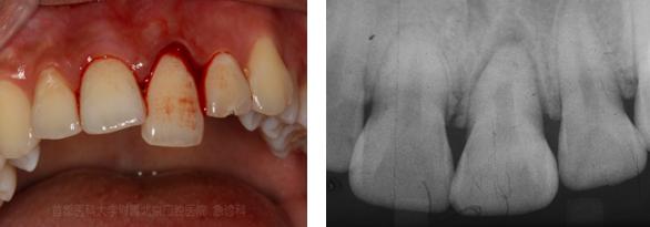 牙齿对于人类而言是非常重要的器官,一口健康的牙齿对于增进食欲,涉取