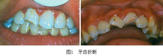 右牙本质折断,牙髓暴露,应当注意的是在冠折的同时多数都存在着牙震荡