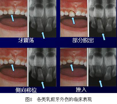从图9中我们可以看到,左上乳中切牙牙齿移位,远离恒牙胚.