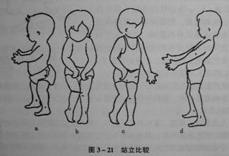 这是脑瘫比较典型的一个 w 坐姿的一个孩子的表现.