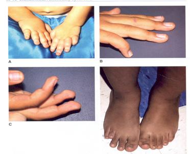 图 6 45,x (turner 综合征 ) 患者图 7 45,x (turner 综合征 ) 患者