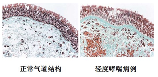 主要内容包括哮喘的概念,哮喘的病理生理机制,支气管的病理特征,重症