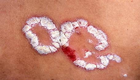 不论何种类型,银屑病都有典型的特点,有蜡滴现象,薄弱现象和点状出血