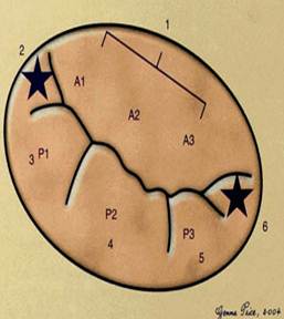 carpentier对壁瓣叶上的扇区及其相对部分的主动脉瓣叶用字母和数字