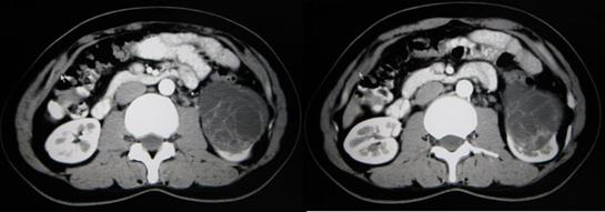 ct显示 左肾下极囊实性占位,其内可见分隔及条索样不规则强化,属于