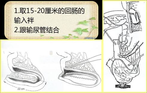 根治性膀胱切除术是目前公认的治疗肌层浸润性膀胱癌和高级别复发性