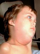 Boy with Mumps