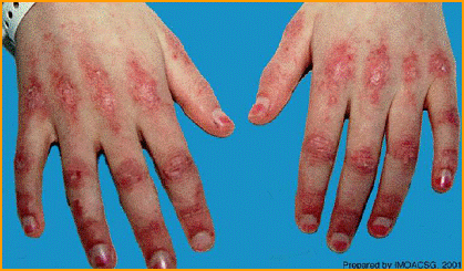 皮肌炎的典型临床表现皮肌炎分成三个不同的亚型,一个是典型的皮肌炎