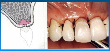 龈瓣的缝合(如下图)根据不同目的,可复位于不同位置,主要有原位复位