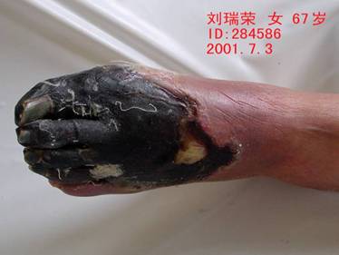 如图1所示为湿性坏疽,该患者是由于左足的第二趾局灶性的坏死,然后
