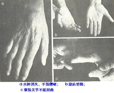 下列哪项不属于肩手综合征第一期的表现( )