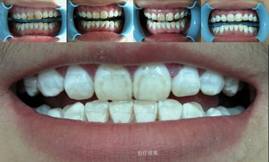 如图所示为 氟斑牙的漂白,可以用去氟净 漂白.